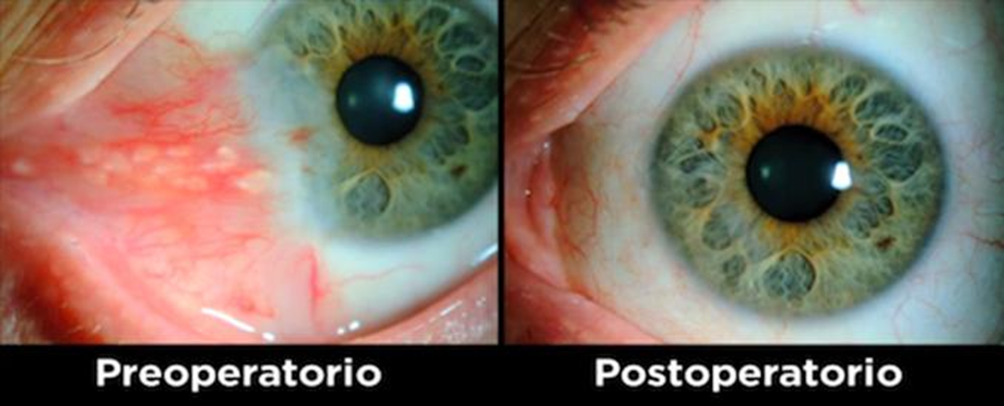 Cirugía pterigion con autoinjerto conjuntival